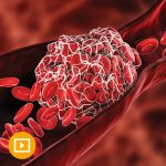 478 Thrombosis And Thromboembolism Cme 12473 150X150 1