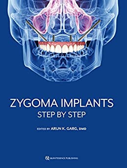 Zygoma Implants: Step by Step (Original PDF from Publisher)