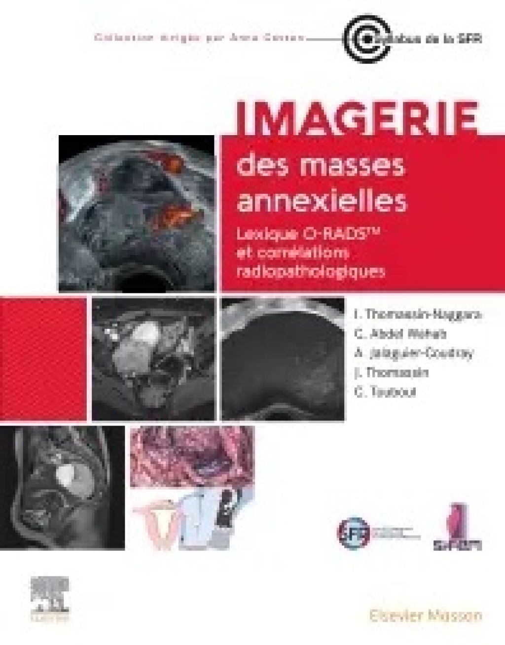 Imagerie des masses annexielles: Lexique O-RADS et corrélations radiopathologiques (True PDF from Publisher)