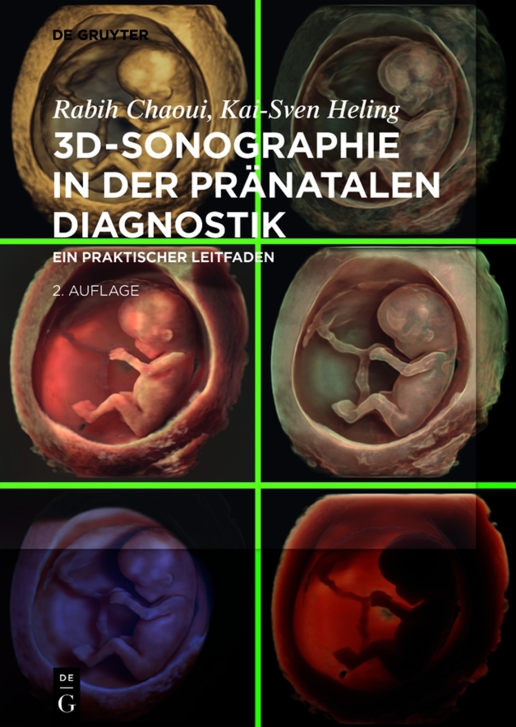 3D-Sonographie in der pränatalen Diagnostik: Ein praktischer Leitfaden, 2nd Edition (Original PDF from Publisher)