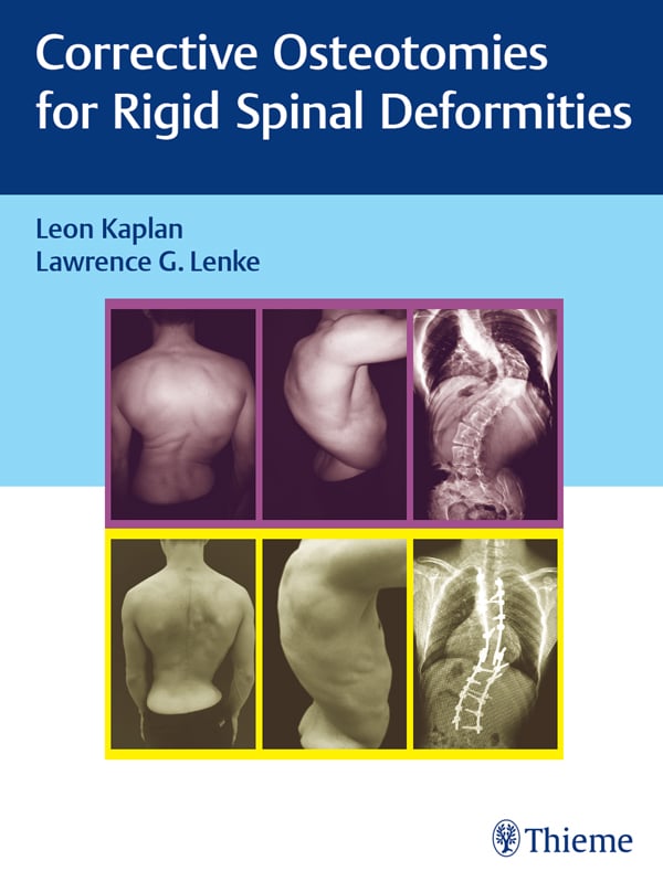 Corrective Osteotomies for Rigid Spinal Deformities (EPUB)