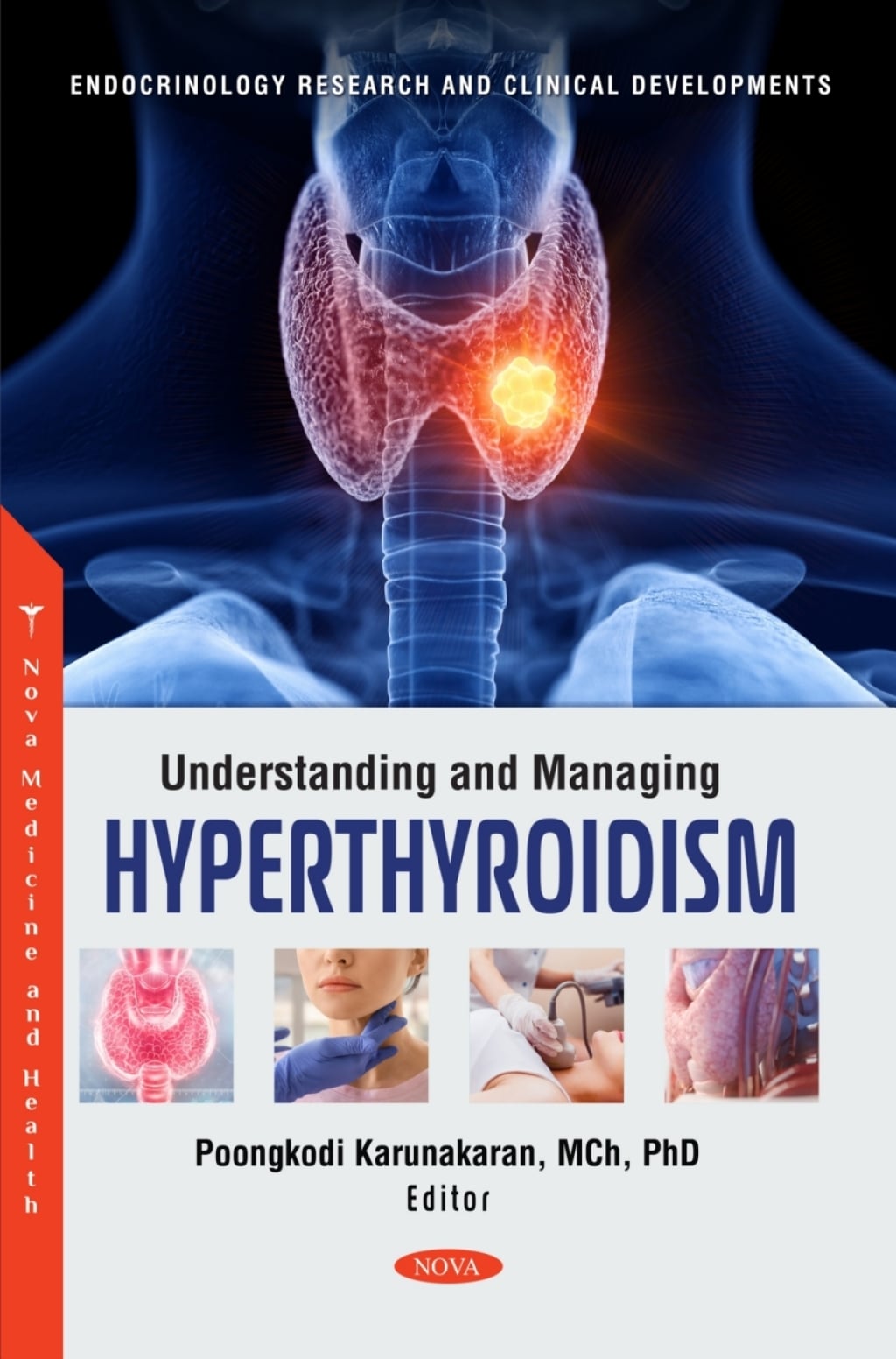 Understanding and Managing Hyperthyroidism (Original PDF from Publisher)