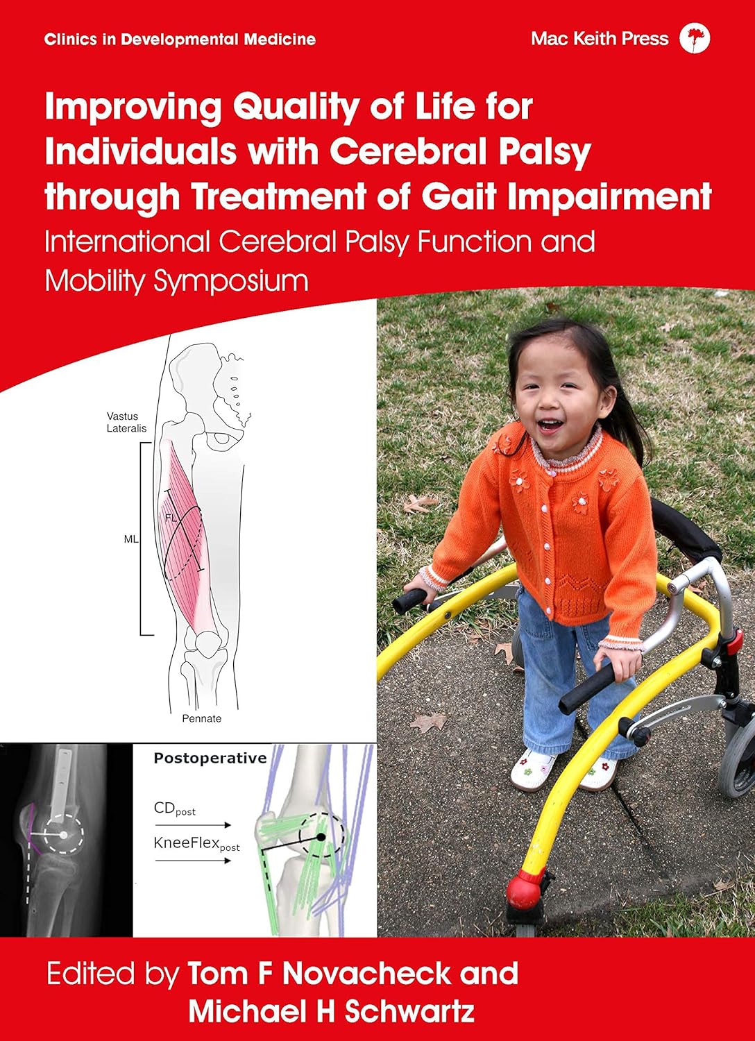 Improving Quality of Life for Individuals with Cerebral Palsy through treatment of Gait Impairment: International Cerebral Palsy Function and Mobility Symposium (Clinics in Developmental Medicine) (EPUB)