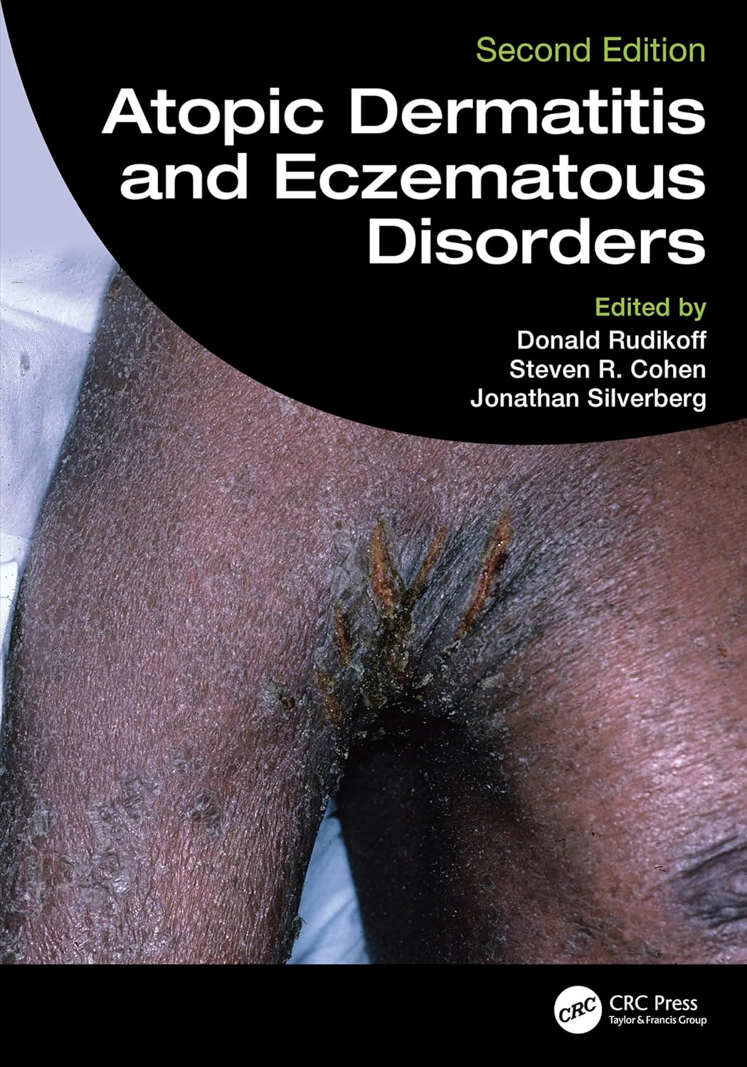 Atopic Dermatitis and Eczematous Disorders, 2nd Edition (Original PDF from Publisher)