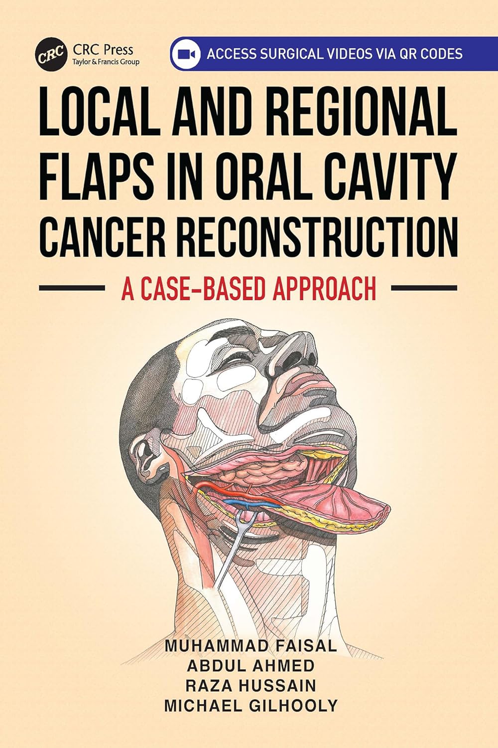 Local and Regional Flaps in Oral Cavity Cancer Reconstruction: A case-based approach (Original PDF from Publisher)