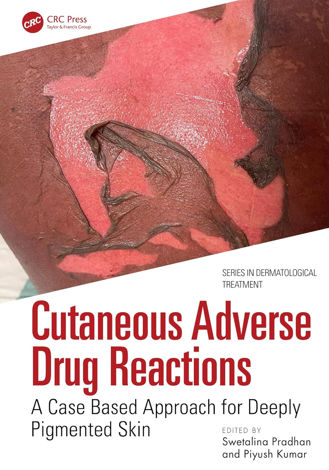 Cutaneous Adverse Drug Reactions: A Case Based Approach for Deeply Pigmented Skin (Series in Dermatological Treatment) (Original PDF from Publisher)
