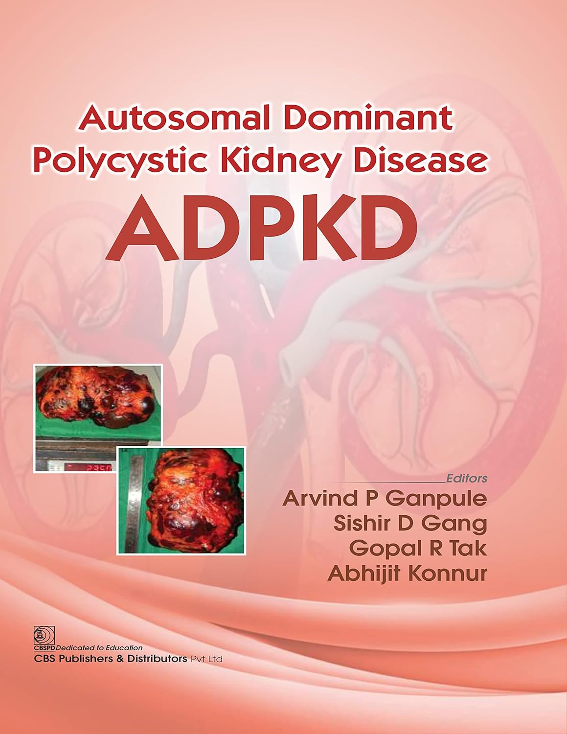 Autosomal Dominant Polytechnic Kidney Disease ADPKD (Original PDF from Publisher)