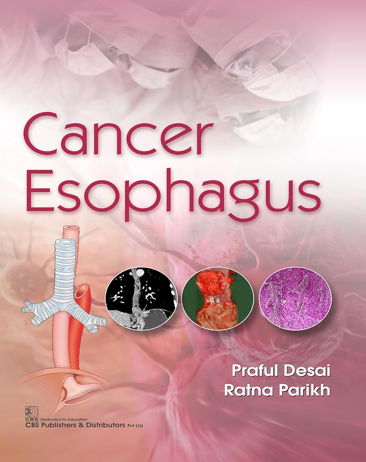 Cancer Esophagus (Original PDF from Publisher)