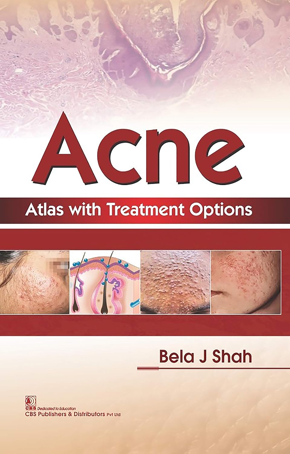 Acne Atlas with Treatment Options (Original PDF from Publisher)