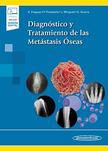 Diagnóstico y Tratamiento de las Metástasis Óseas (Original PDF from Publisher)